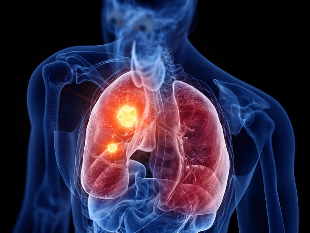 Lung Cancer