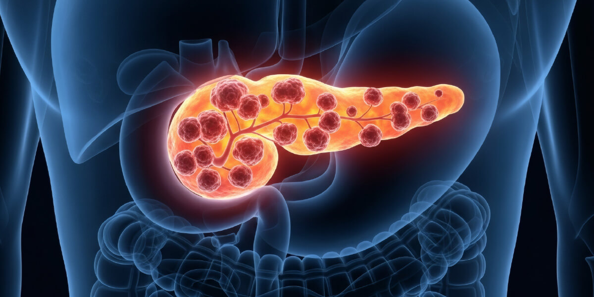 Pancreas cancer